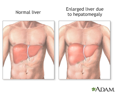 Hepatomegaly Information Mount Sinai New York