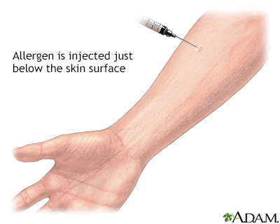 Aspergillus antigen skin test