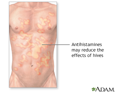 Will an antihistamine stop an allergic reaction