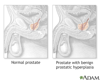 Hyperplasia