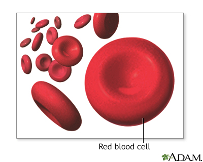 Anemia caused by low iron - children Information | Mount Sinai - New York