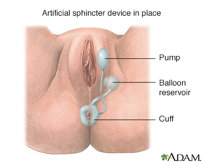 Faecal Incontinence (Bowel Incontinence) - General Information