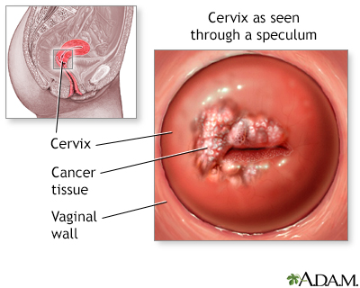 Pap smears and cervical cancer - Illustration Thumbnail              