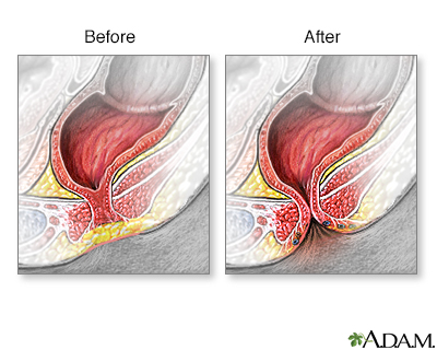 Imperforate anus - Illustration Thumbnail
                      