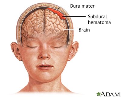 Subdural hematoma - Illustration Thumbnail							