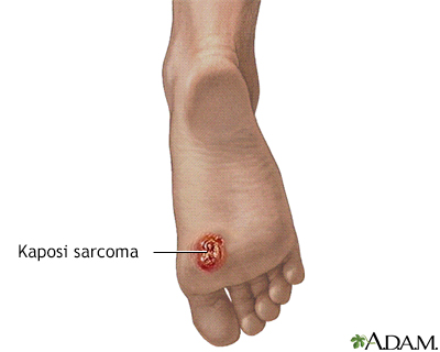 Kaposi sarcoma on foot