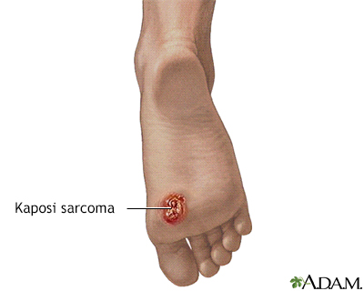 Kaposi sarcoma on foot - Illustration Thumbnail
                      