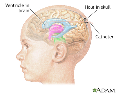 Intracranial pressure monitoring - Illustration Thumbnail
                      