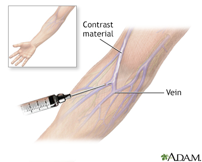 Intravenous pyelogram - Illustration Thumbnail
              