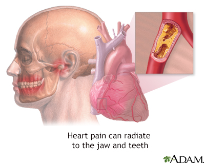 Chest Pain Information Mount Sinai New York