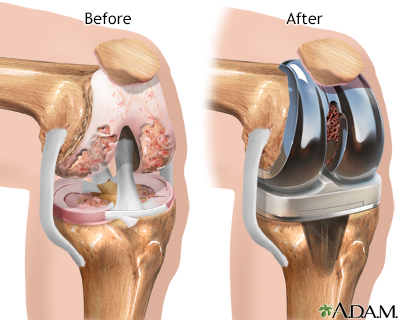 Knee joint replacement prosthesis - Illustration Thumbnail
              