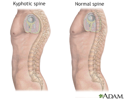 Thoracic Lumbar Sacral Orthosis with Zero Degree Lordosis Curve