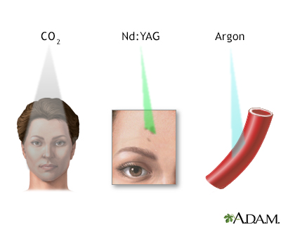 Laser therapy - Illustration Thumbnail
              