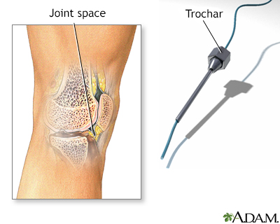 Synovial biopsy - Illustration Thumbnail
              