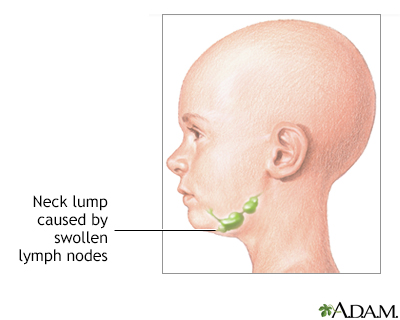 Neck Lump Information Mount Sinai New York