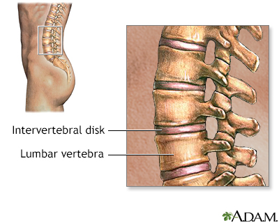 Lumbar Sprain/Lower Back Sprain NJ & NYC