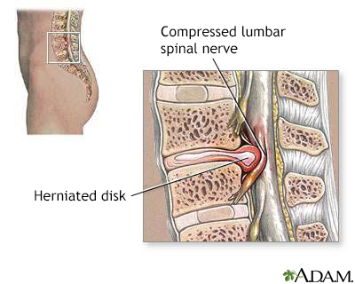 Spine Condition - Herniated Disc