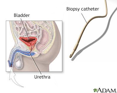 Bladder biopsy - Illustration Thumbnail
                      