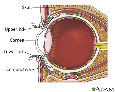 Pinguecula (Yellow Bump on Eyeball): Diagnosis, Causes & Treatment