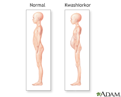 Kwashiorkor symptoms - Illustration Thumbnail
                      