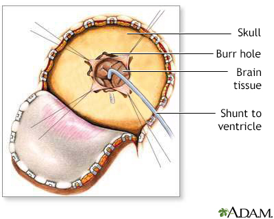 Craniotomy for cerebral shunt - Illustration Thumbnail
              