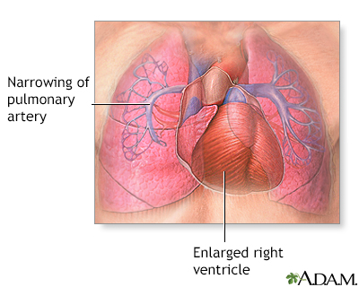 Chest pain Information  Mount Sinai - New York