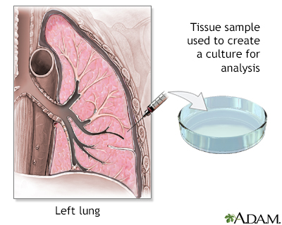 Lung tissue biopsy - Illustration Thumbnail              