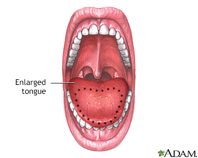 amiloidosis por macroglosia