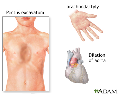 Marfan syndrome hallmarks: claw-shaped hand with long fingers (a