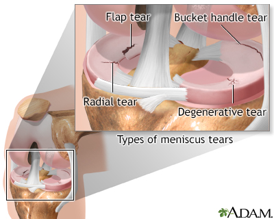 Torn Meniscus Knee Brace for Cartilage Tears & Degeneration