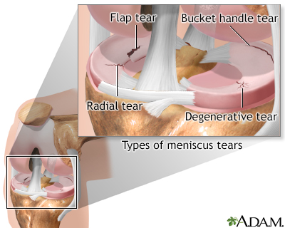 Meniscal tears - Illustration Thumbnail              