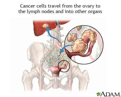 Ovarian cancer metastasis - Illustration Thumbnail              