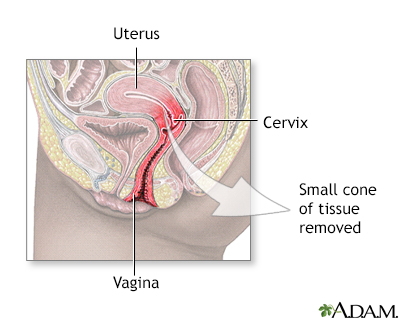 Cold cone removal - Illustration Thumbnail
              