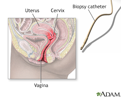 Endometrial biopsy - Illustration Thumbnail
              