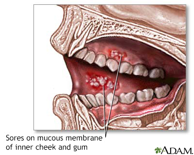 mouth ulcer