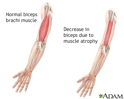 Muscle Pain  Common Causes & Treatment