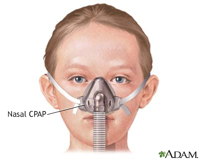 Nasal CPAP - Illustration Thumbnail
                      