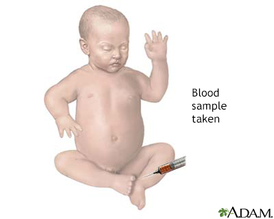 Infant blood sample - Illustration Thumbnail              