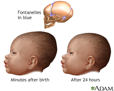 2 month old misshapen 2024 head