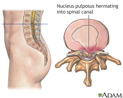 Herniated nucleus pulposis