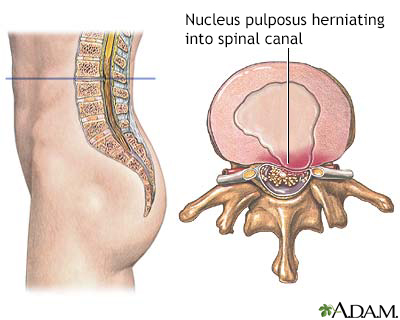 Type 2. The herniated disc was clearly separated from the disc of