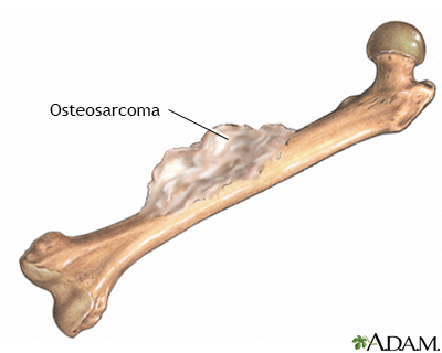 Bone tumor - Illustration Thumbnail
                      