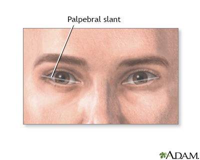 oblique palpebral fissures