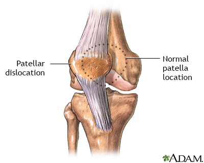 Patellar dislocation - Illustration Thumbnail
                      