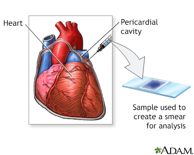 Pericardial fluid culture - Illustration Thumbnail
              