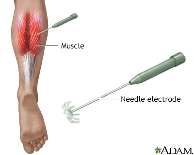 emg test for lower back pain