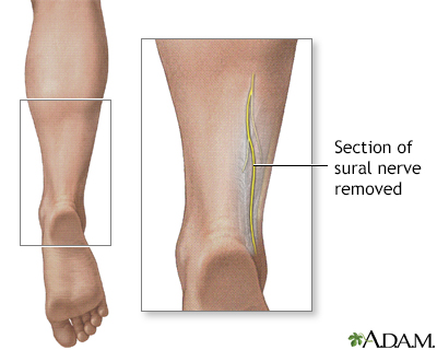 Nerve biopsy - Illustration Thumbnail              