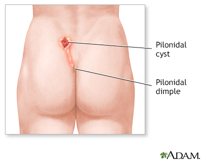 Pilonidal dimple: MedlinePlus Medical Encyclopedia Image