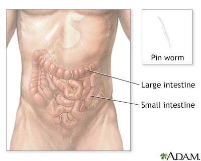 Hermaphrodit pinworms. A lefedett kulcsterületek