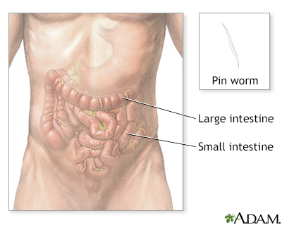 rectal parasite worm